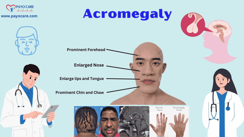Acromegaly: Types, Causes, Symptoms, Prevention & Treatment Acromegaly: Types, Causes, Symptoms, Prevention & Treatment