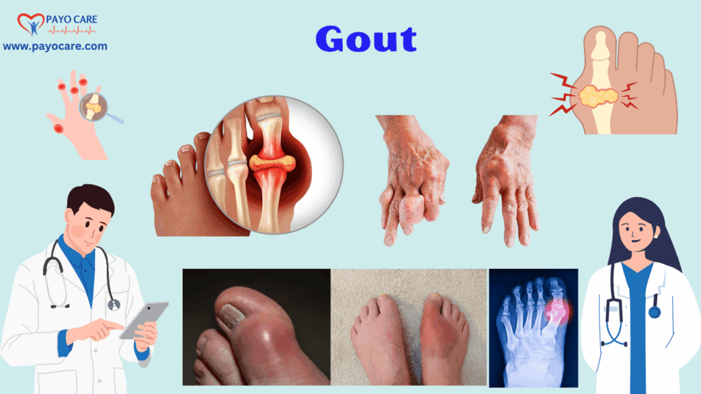 Gout: Types, Causes, Symptoms, Prevention, Diagnosis & Treatment Gout: Types, Causes, Symptoms, Prevention, Diagnosis & Treatment
