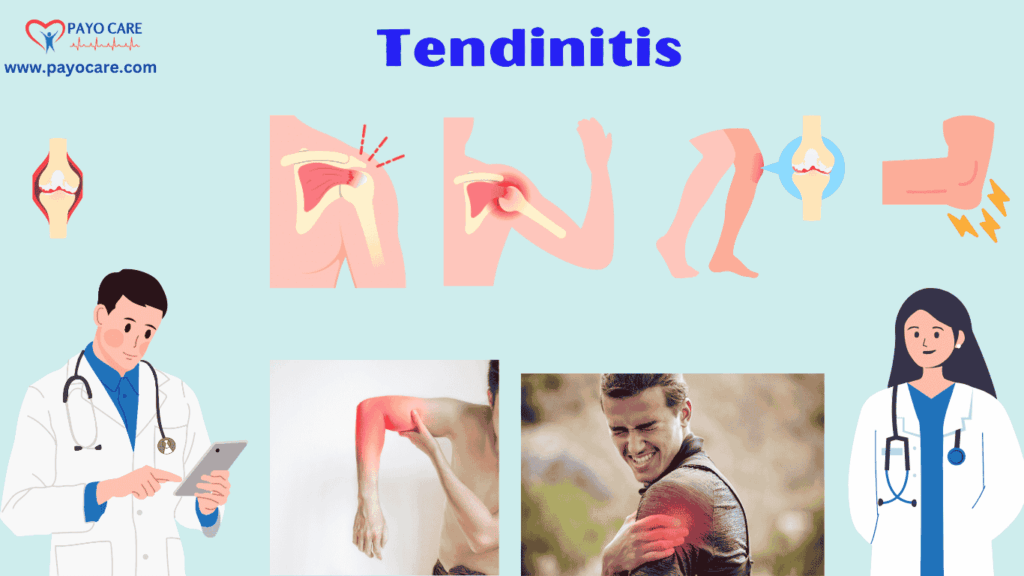 Tendinitis: Types, Causes, Symptoms, Prevention, Diagnosis & Treatment Tendinitis: Types, Causes, Symptoms, Prevention, Diagnosis & Treatment