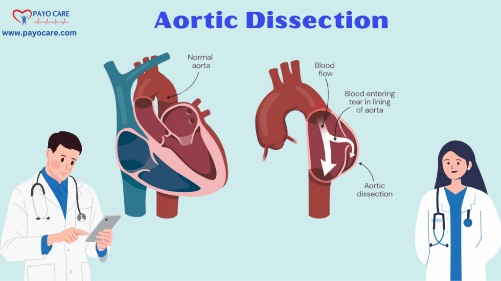 Aortic Dissection: Types, Causes, Symptoms, Prevention and Treatment Aortic Dissection: Types, Causes, Symptoms, Prevention and Treatment