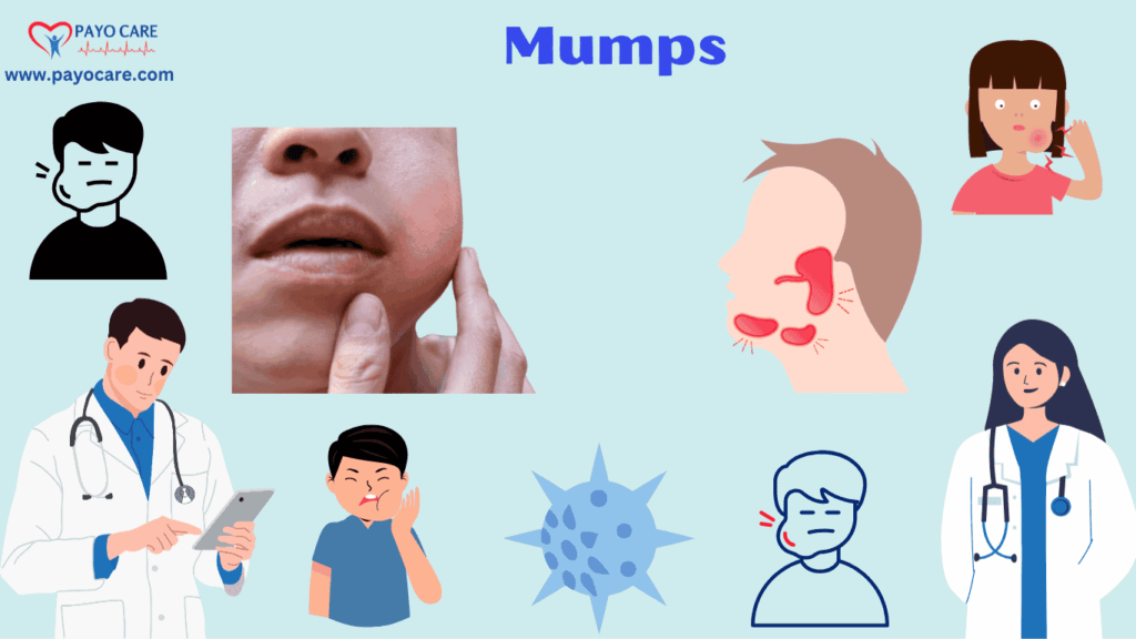 Mumps: Types, Causes, Symptoms, Prevention, Diagnosis, and Treatment