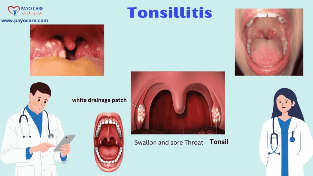 Tonsillitis: Types, Causes, Symptoms, Prevention, and Treatment Tonsillitis: Types, Causes, Symptoms, Prevention, and Treatment