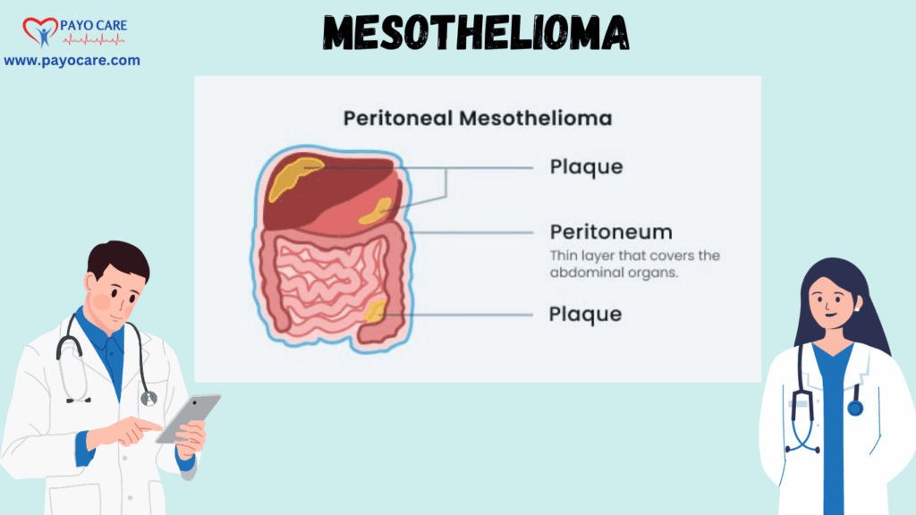 Mesothelioma :Types, Causes, Symptoms, Prevention, Diagnosis, and Treatment Mesothelioma :Types, Causes, Symptoms, Prevention, Diagnosis, and Treatment